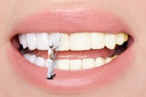 יישור שיניים באמצעות ציפוי
