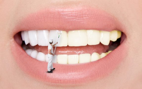 יישור שיניים באמצעות ציפוי