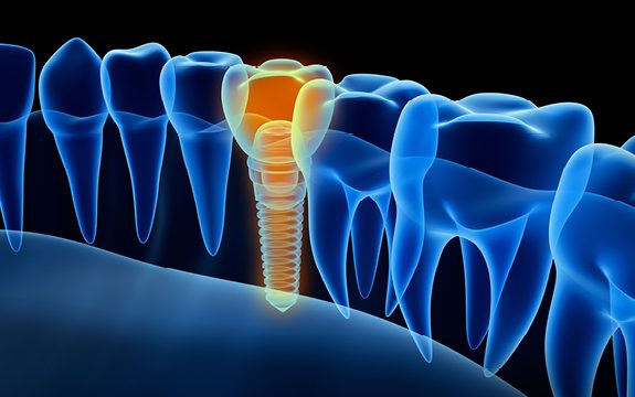 השתלות שיניים תופעות לוואי