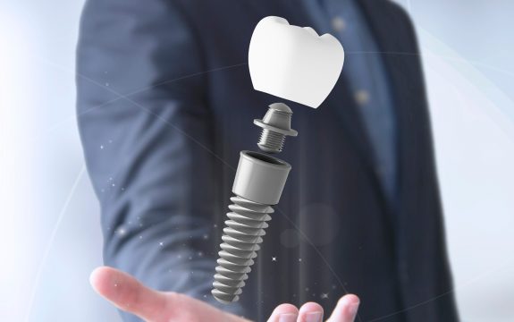 השתלת שיניים בכל הפה